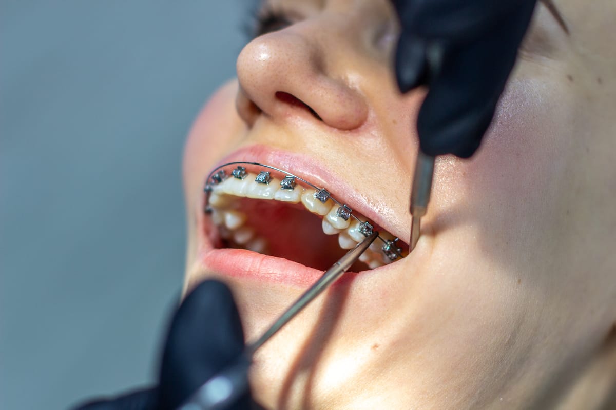 A woman with dental braces visits an orthodontist in the clinic, in a dental chair. during the procedure of installing the arch of braces on the upper and lower teeth. The dentist is wearing gloves and has dental instruments in his hands. The concept of dentistry