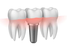 Implantologia_monza_brianza